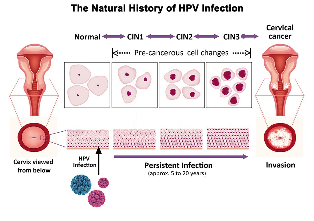 什么时候才能治愈HPV病毒？