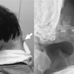 日本25岁男子沉迷手游致脖子长角：无法抬起头 出现吞咽困难